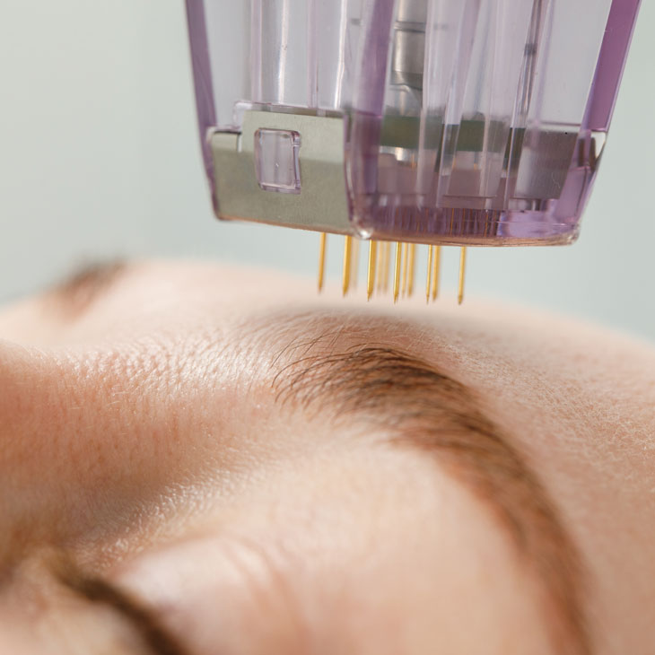 Binsina Skin & Laser Clinic - Microneedling 2