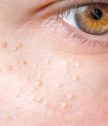 Binsina Skin & Laser Clinic - Milia 2