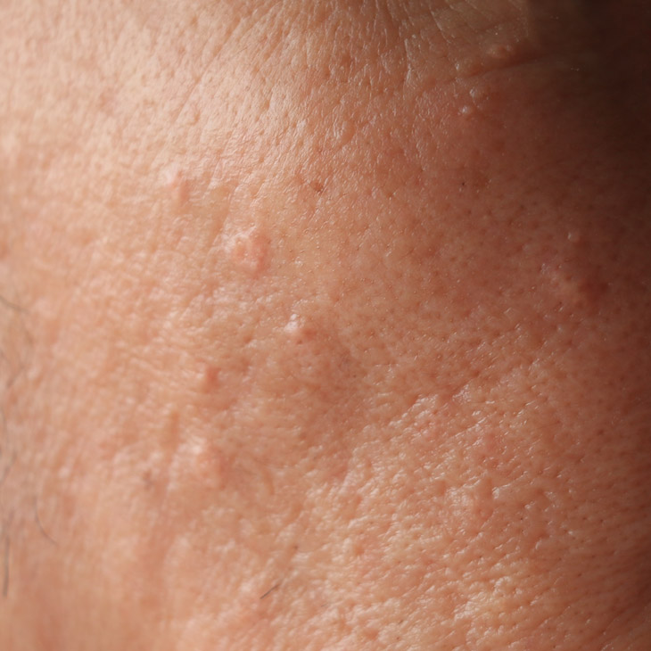 Binsina Skin & Laser Clinic - Milia 3