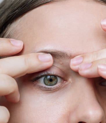 Binsina Skin & Laser Clinic - Milia