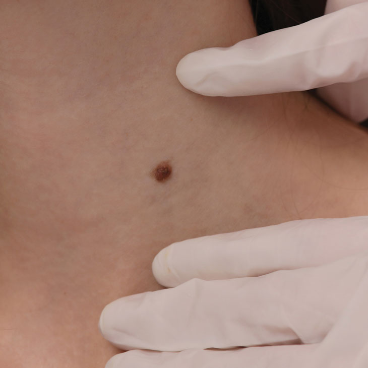 Binsina Skin & Laser Clinic - Mole Removal 2