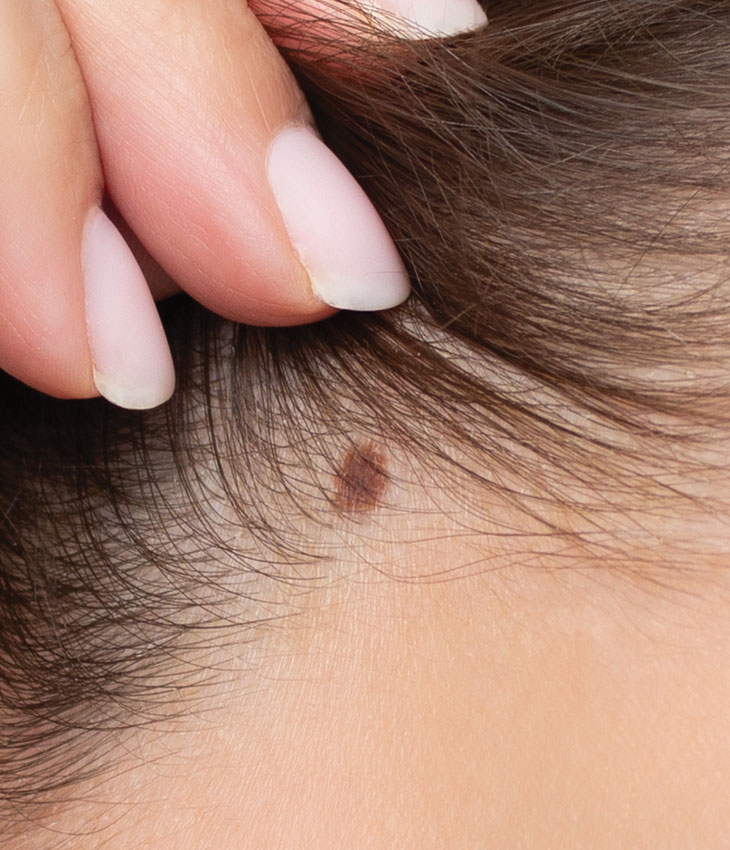 Binsina Skin & Laser Clinic - Mole Removal 3