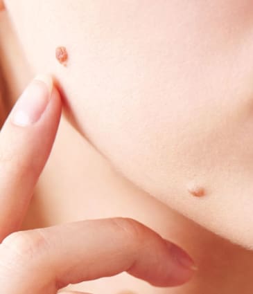 Binsina Skin & Laser Clinic - Mole Removal 4