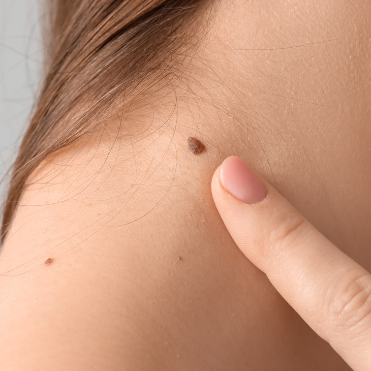 Binsina Skin & Laser Clinic - Moles 3