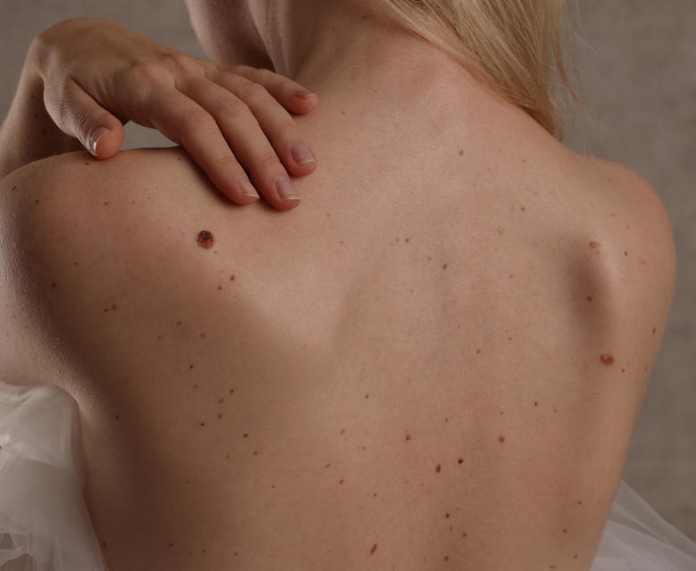 Binsina Skin & Laser Clinic - Moles