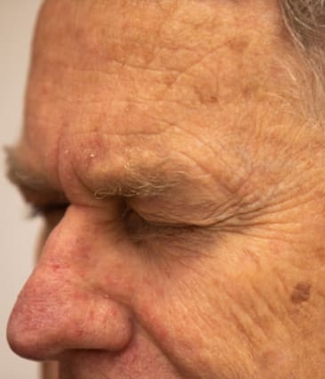 Binsina Skin & Laser Clinic - Post Inflammatory Hyperpigmentation 2