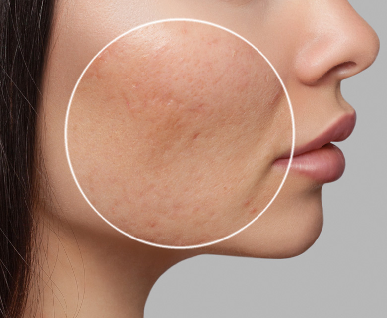 Binsina Skin & Laser Clinic - Post Inflammatory Hyperpigmentation