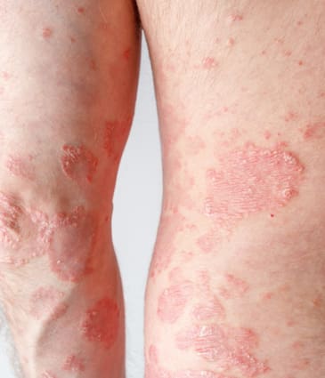 Binsina Skin & Laser Clinic - Psoriasis