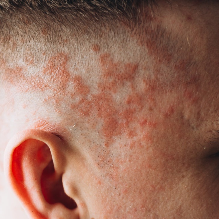 Binsina Skin & Laser Clinic - Psoriasis