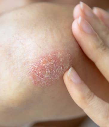 Binsina Skin & Laser Clinic - Psoriasis
