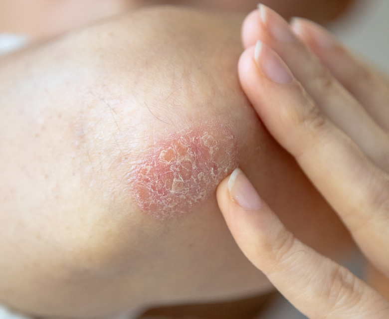 Binsina Skin & Laser Clinic - Psoriasis