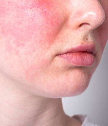 Binsina Skin & Laser Clinic - Rosacea 2