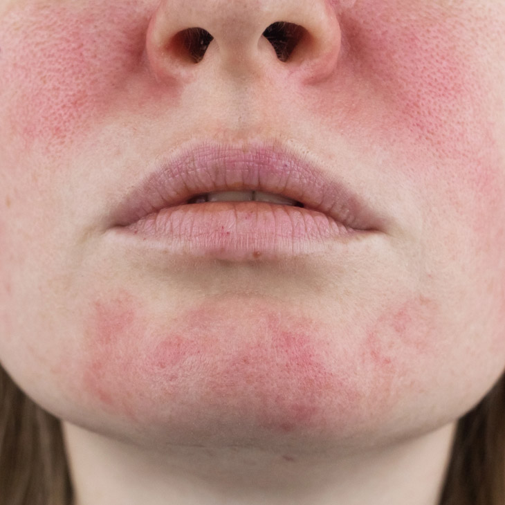 Binsina Skin & Laser Clinic - Rosacea 3