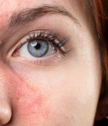 Binsina Skin & Laser Clinic - Rosacea