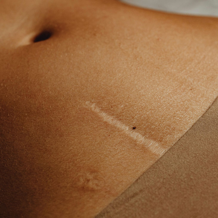 Binsina Skin & Laser Clinic - Scar treatment 2