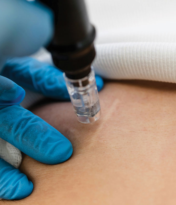 Binsina Skin & Laser Clinic - Scar treatment 3