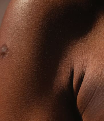 Binsina Skin & Laser Clinic - Scar treatment 4