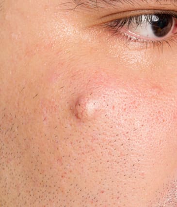 Binsina Skin & Laser Clinic - Sebaceous Cyst 2