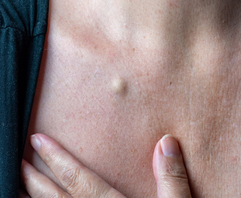 Binsina Skin & Laser Clinic - Sebaceous Cyst