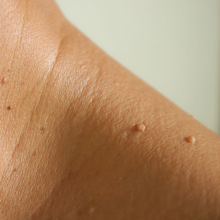Binsina Skin & Laser Clinic - Skin Tag Removal 2