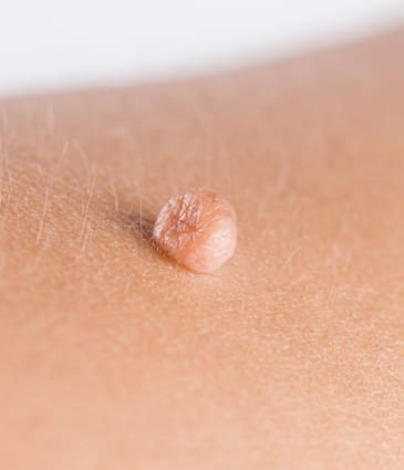 Binsina Skin & Laser Clinic - Skin Tags 2