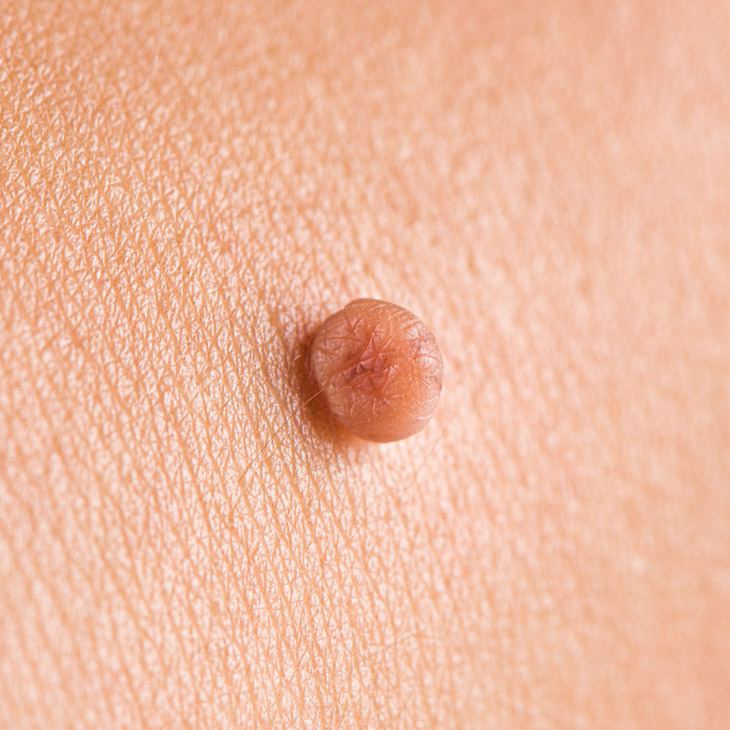 Binsina Skin & Laser Clinic - Skin Tags 3