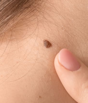 Binsina Skin & Laser Clinic - Skin Tags