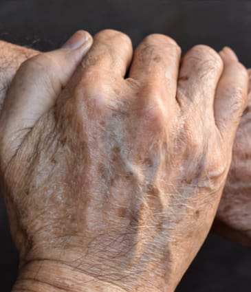 Binsina Skin & Laser Clinic - Solar Lentigimes 2