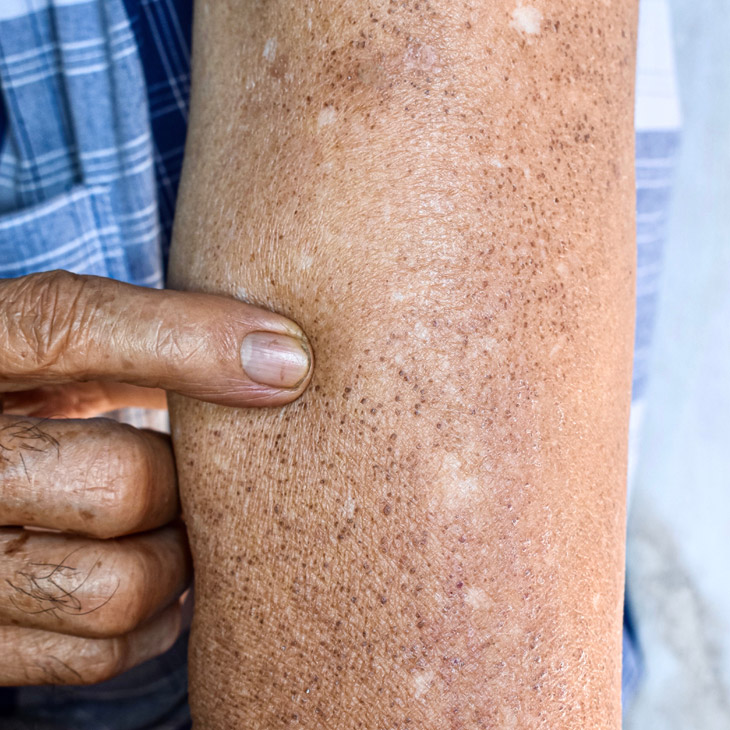 Binsina Skin & Laser Clinic - Solar Lentigimes 3