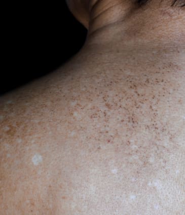 Binsina Skin & Laser Clinic - Solar Lentigimes