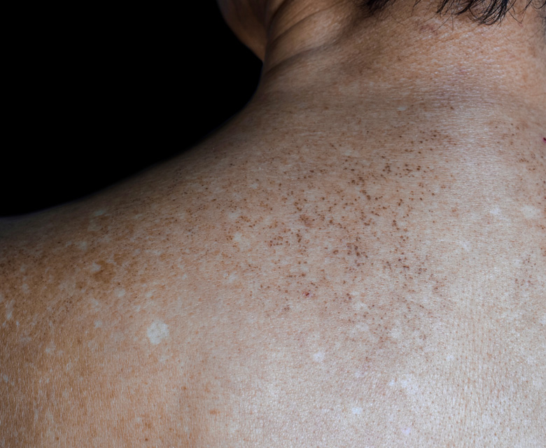 Binsina Skin & Laser Clinic - Solar Lentigimes