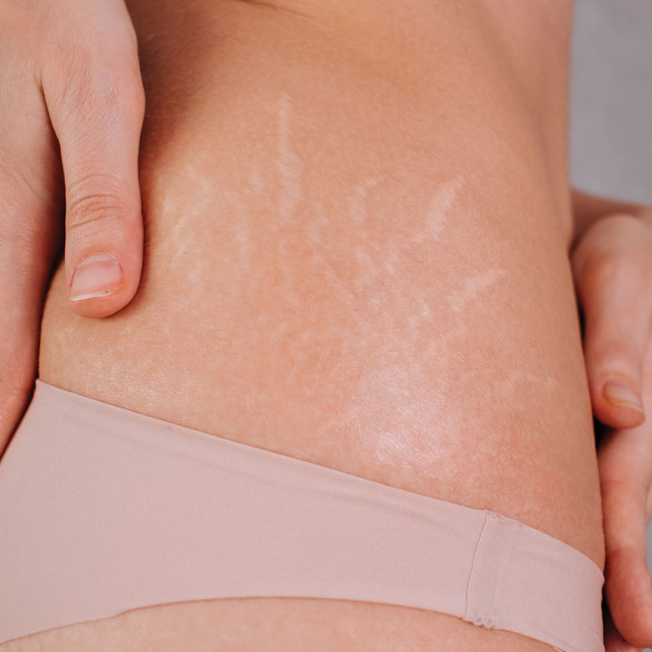 Binsina Skin & Laser Clinic - Stretch Marks 2