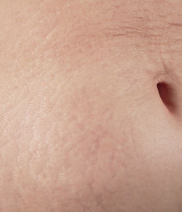 Binsina Skin & Laser Clinic - Stretch Marks 2