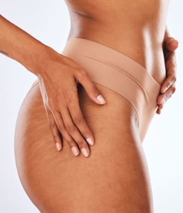 Binsina Skin & Laser Clinic - Stretch Marks 4