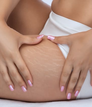 Binsina Skin & Laser Clinic - Stretch Marks