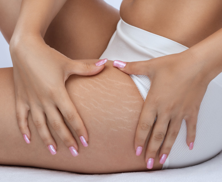 Binsina Skin & Laser Clinic - Stretch Marks