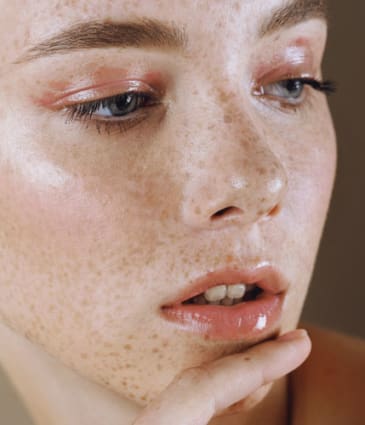 Binsina Skin & Laser Clinic - Sun Damage - Pigmentation 4