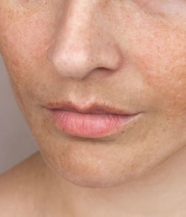 Binsina Skin & Laser Clinic - Sun Damage - Pigmentation
