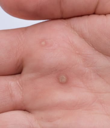 Binsina Skin & Laser Clinic - Warts & Verrucas 2