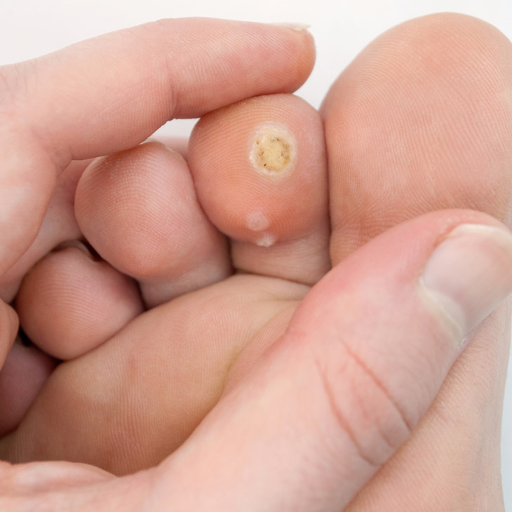 Binsina Skin & Laser Clinic - Warts & Verrucas 3