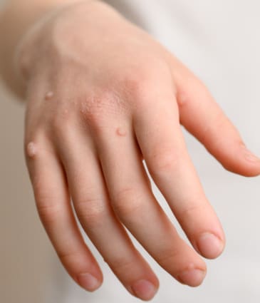 Binsina Skin & Laser Clinic - Warts & Verrucas