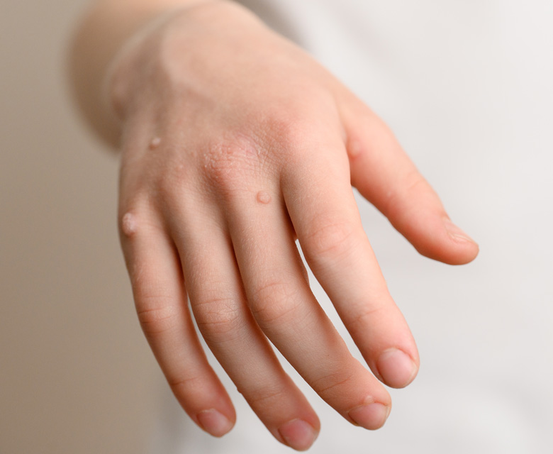 Binsina Skin & Laser Clinic - Warts & Verrucas