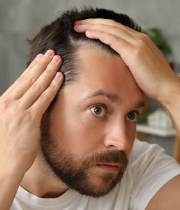 Binsina Skin & Laser Clinic - Thinning Hair - Hair Loss 2