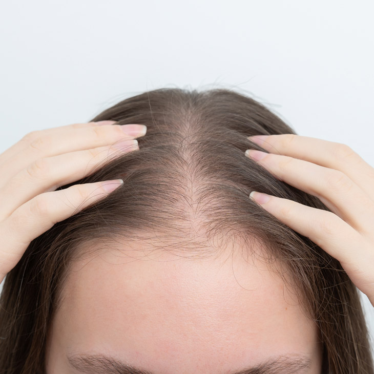 Binsina Skin & Laser Clinic - Thinning Hair - Hair Loss 3