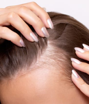 Binsina Skin & Laser Clinic - Thinning Hair - Hair Loss