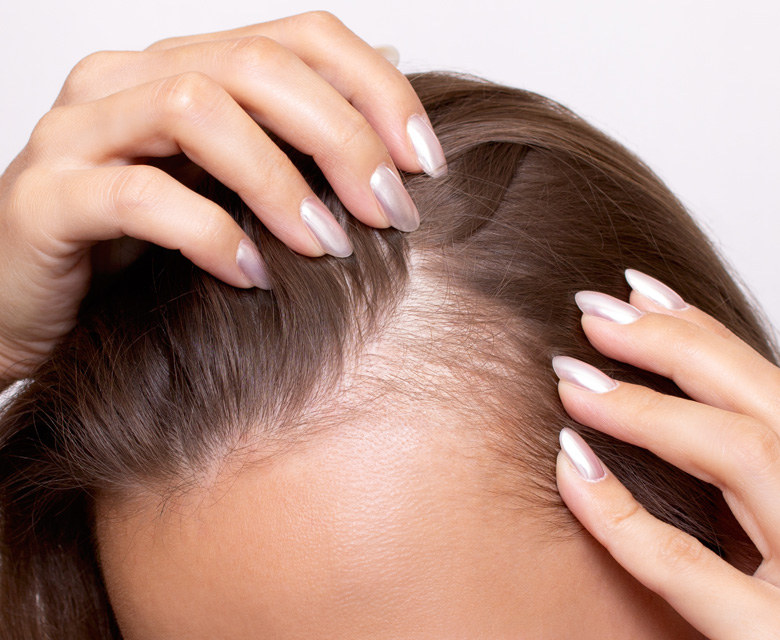 Binsina Skin & Laser Clinic - Thinning Hair - Hair Loss