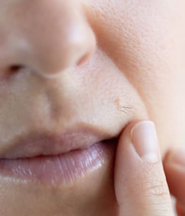 Binsina Skin & Laser Clinic - Unwanted - Excess Hair