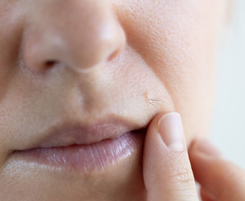 Binsina Skin & Laser Clinic - Unwanted - Excess Hair