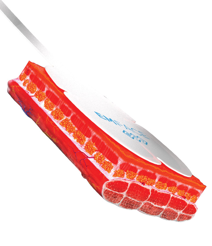 Binsina Laser Clinic - EMFACE 2